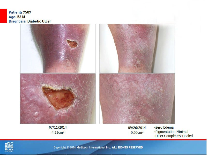 BIOFLEXLaser's tweet photo. #Bioflexlaser Accelerated healing for #diabetes. Scientifically proven to work!
https://t.co/YE7uI4YhVv
Our systems are designed to deliver precise dosages of photon particles to effectively treat the pain associated with an extensive number of clinical pathologies.
#LLLT https://t.co/jiKNd0bqfP