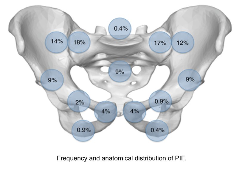 ColorectalDis's tweet photo. Pelvic insufficiency fractures more common post chemoradiotherapy for rectal cancer. Results from Danish national cohort. Higher risk in females and age >65. #colorectalresearch #colorectalsurgery
https://t.co/Iqa5pBzCVB https://t.co/OWlUJUIff1