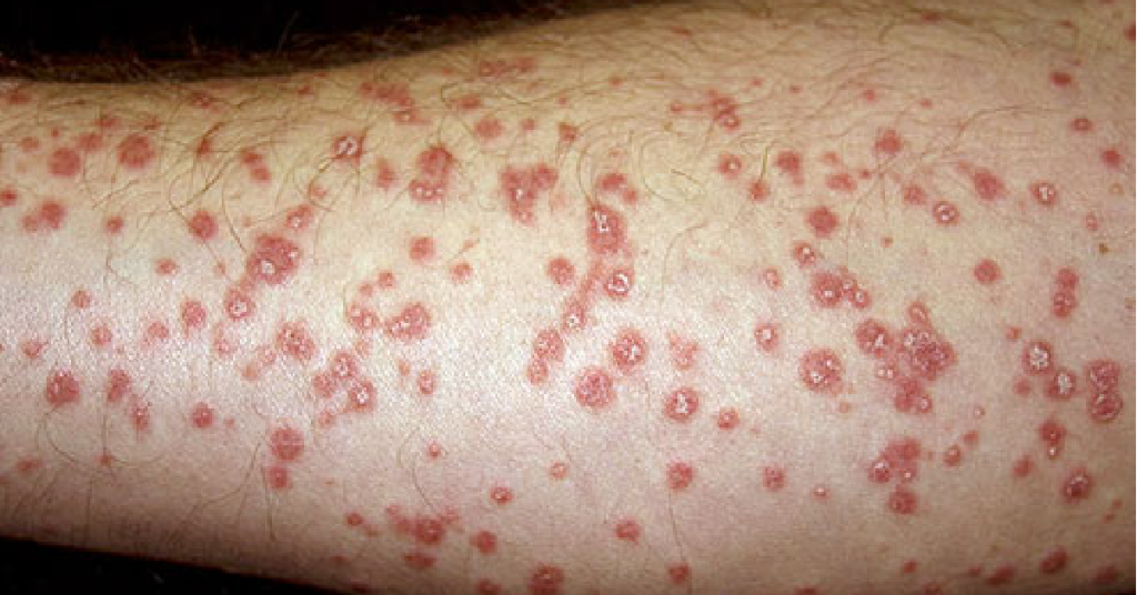 Psoriasis vulgaris g Possible complications for psoriasis