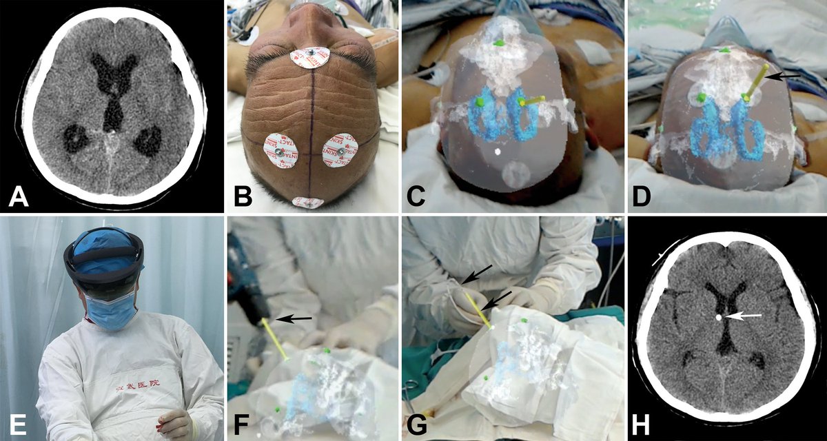 “A wearable mixed-reality holographic computer for guiding external ventricular drain insertion at the bedside,” by Ye Li, M.D., Ph.D., and colleagues, published in the Journal of Neurosurgery (thejns.org/doi/full/10.31…).