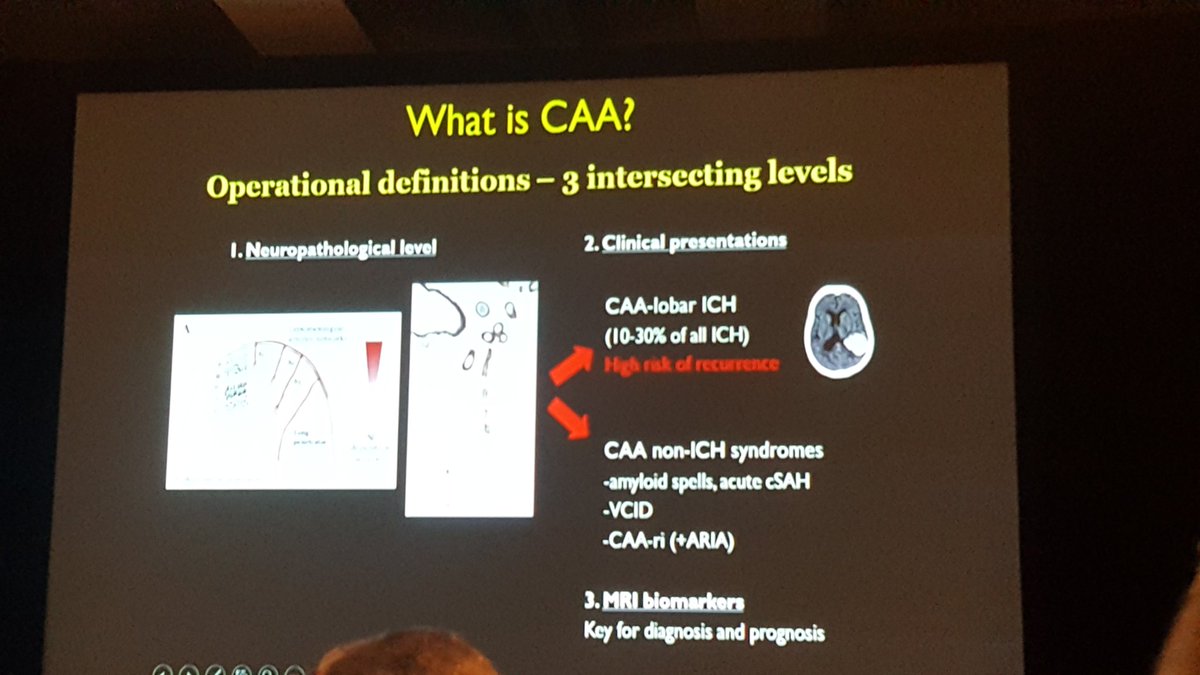 #WSC2018 #worldstroke2018  esoterics . Good to stimulate the cortex.  And let us NOT forget the common stuff #atherosclerosis #atrialfibrillation #amyloidangiopathy