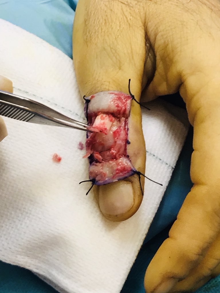 Pulgar en martillo (closed mallet thumb). Una entidad muy poco frecuente en  pulgar. En este caso, tratamiento quirúrgico por retracción tendinosa en  ECO con abordaje en H y con reinserción de extensor, image size:768x1024