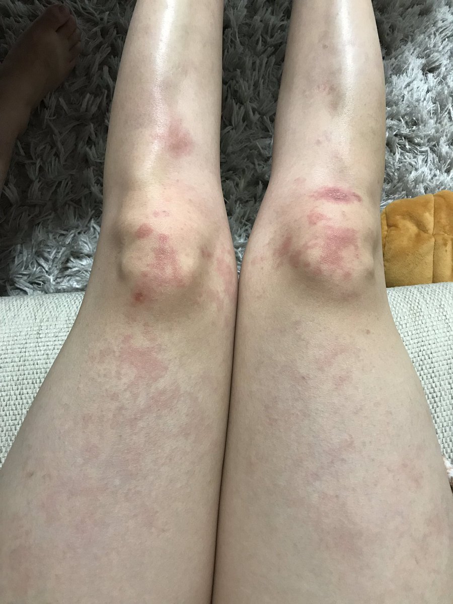 足 に 赤い 斑点 痒く ない 画像