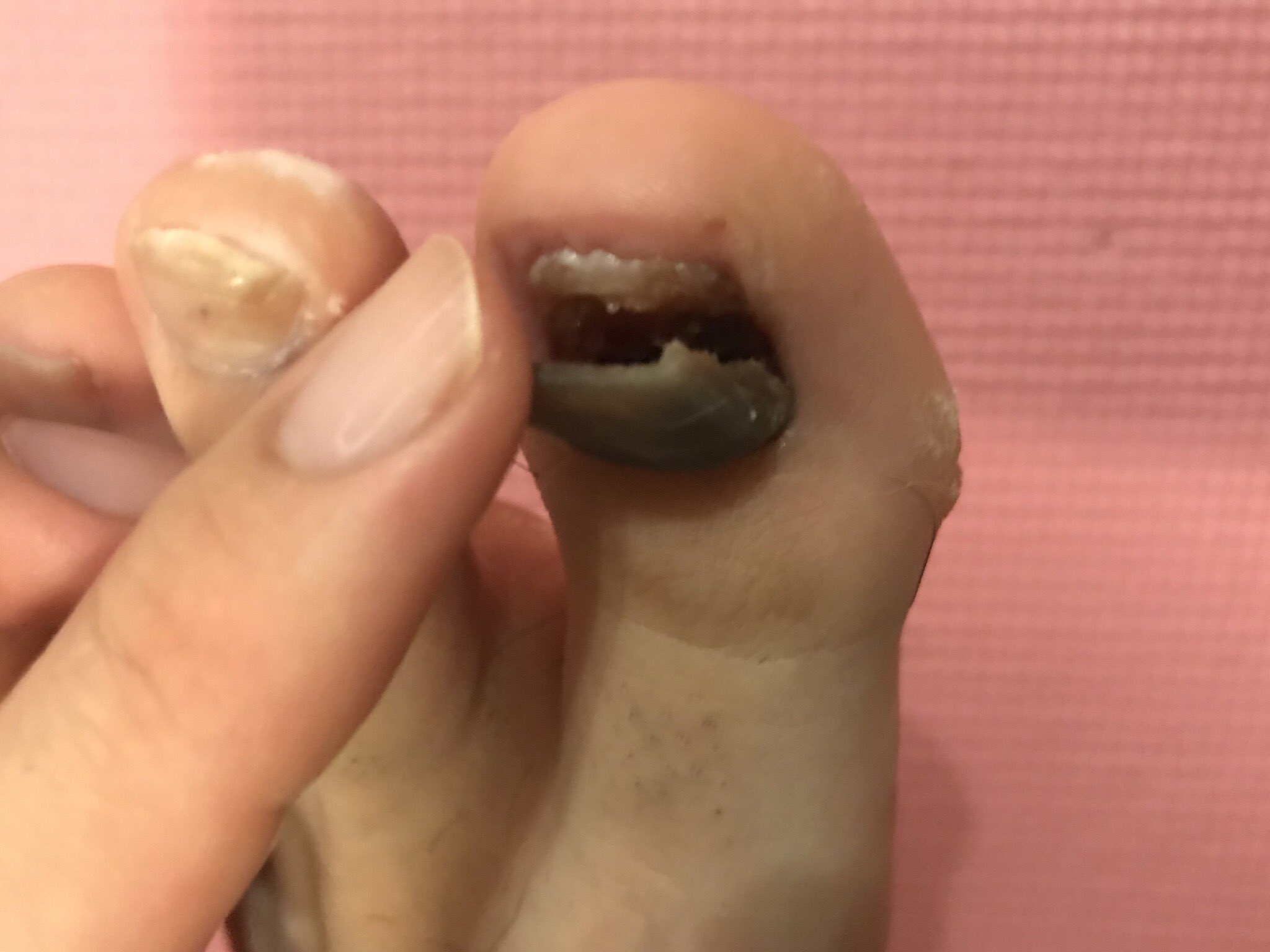 デルピエロ山口 発毛芸人 No Twitter 爪が真っ黒になって数ヶ月 今風呂から出たらパックリ開いた 死んだ爪が根元の新しい爪と結合してて剥がれない どうしたらいいんだろうか デルピエロ山口 発毛芸人 No Twitter 爪が真っ黒になって数ヶ月 今風呂から出たらパックリ開いた 死んだ爪が根元の新しい爪と結合してて剥がれない どうしたらいいんだろうか