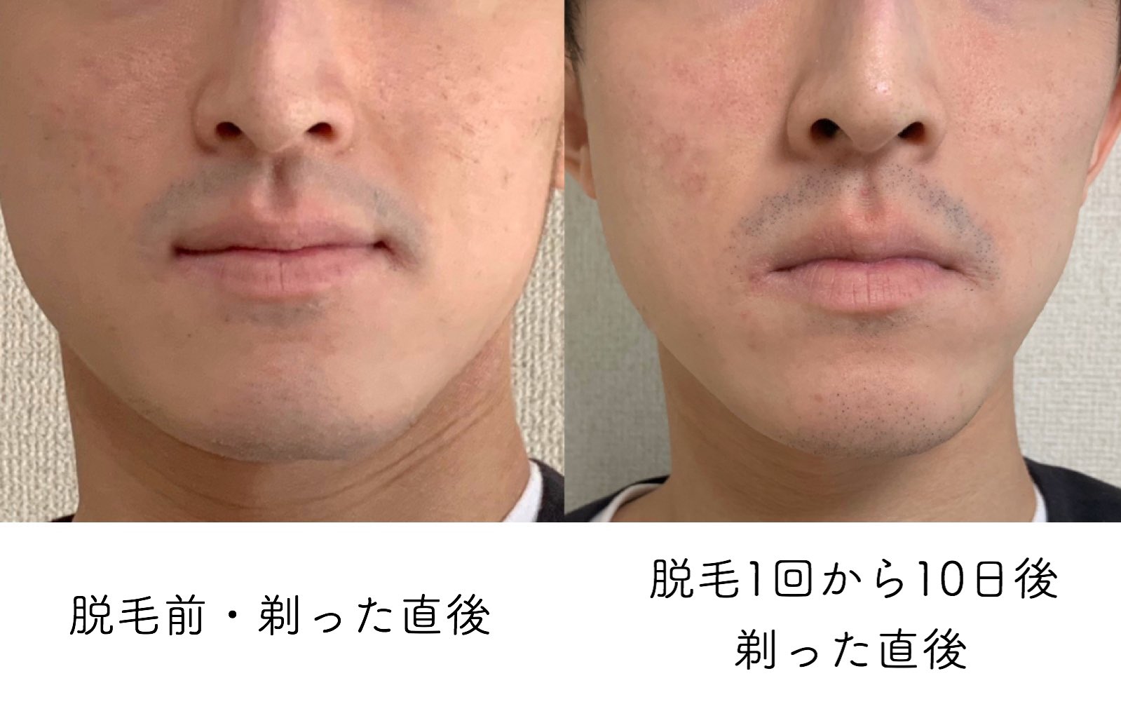 تويتر しぶ على تويتر 脱毛1回目の報告 脱毛後7日 10日で効果がわかるということで 10日経った時点の様子を記録 伸びるスピードが2 3ほどに 脱毛直後は根元が膨張して濃くなる という噂は本当 現時点だと脱毛前より青髭が目立つ 毛先が細く柔らかく