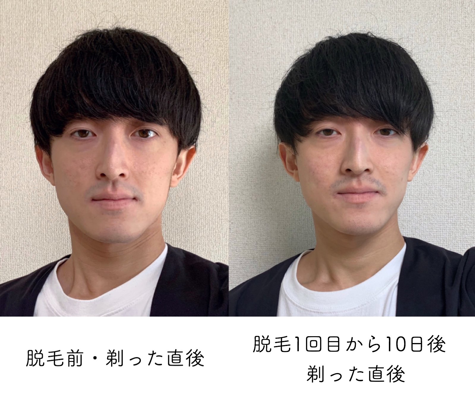 Twitter 上的 しぶ 脱毛1回目の報告 脱毛後7日 10日で効果がわかるということで 10日経った時点の様子を記録 伸びるスピードが2 3ほどに 脱毛直後は根元が膨張して濃くなる という噂は本当 現時点だと脱毛前より青髭が目立つ 毛先が細く柔らかくなっ