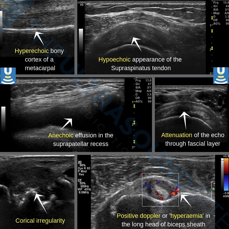 Ultrasound in carpal tunnel syndrome The Ultrasound Site