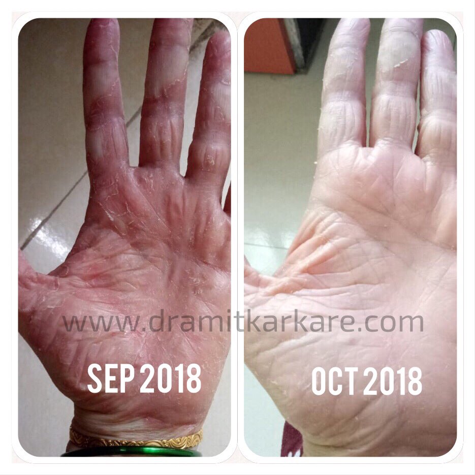 Day starts with these amazing pictures in my inbox. Homeopathy is amazingly satisfying!
#healingwithfeelings #homeopathy #dramitkarkare #swaroopclinic #atopicdermatitis #atopi #dermatology #skinallergy