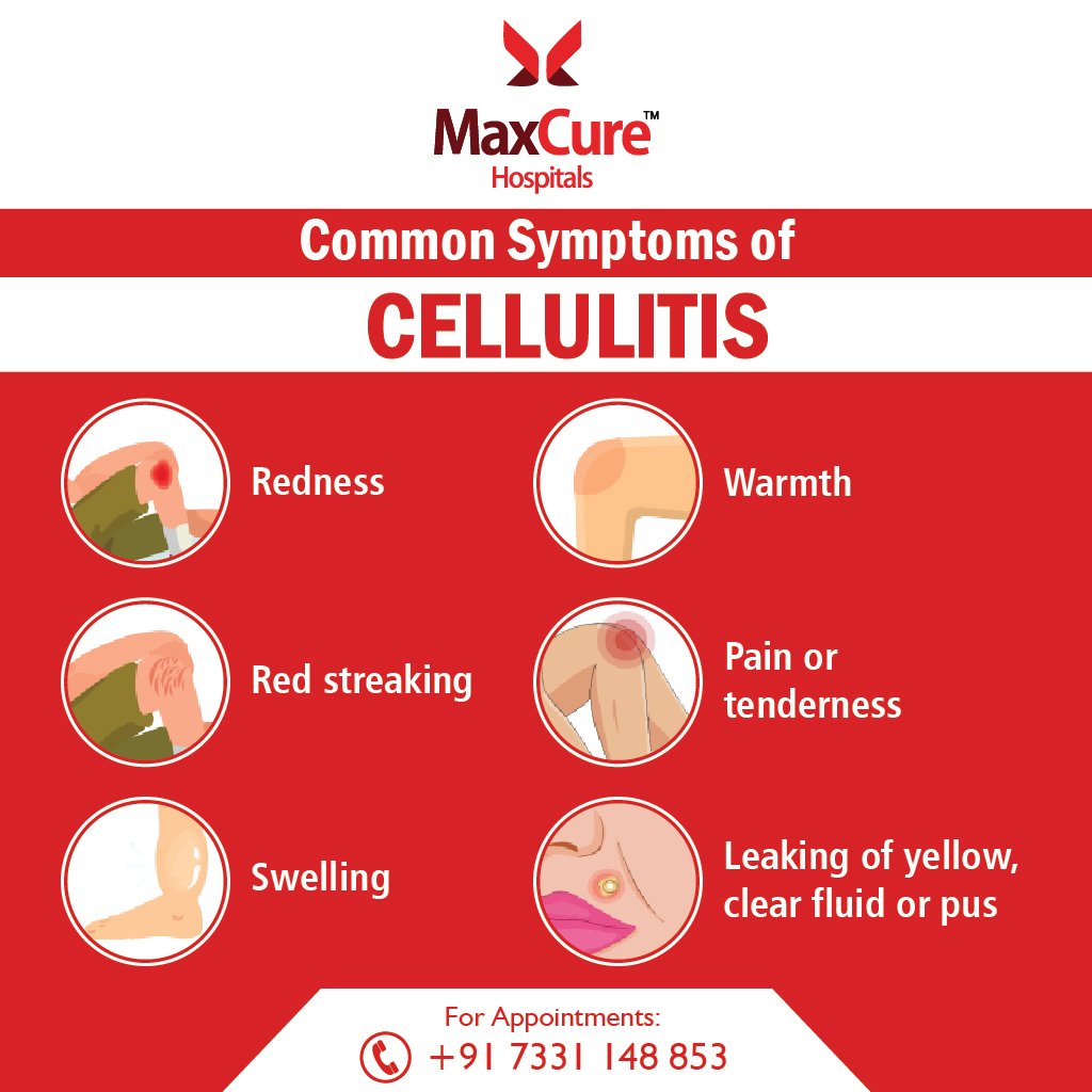 Cellulitis Infection Symptoms