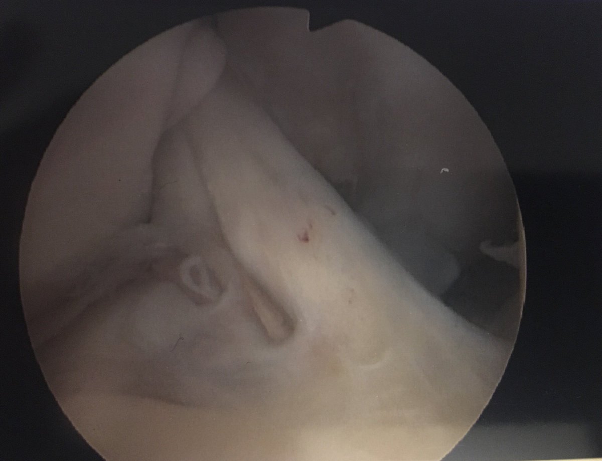 1 year post ACL reconstruction, 2 surgeries and I have been cleared by my surgeon!! Below is my new healthy ACL. What a journey. It’s far from over though. Time to smash those quad/hamstring ratios with <a href="/SL_Physio/">Stronglines Physio</a>💪🏻. The comeback is on⚽️. Thank you for all the amazing support❤️