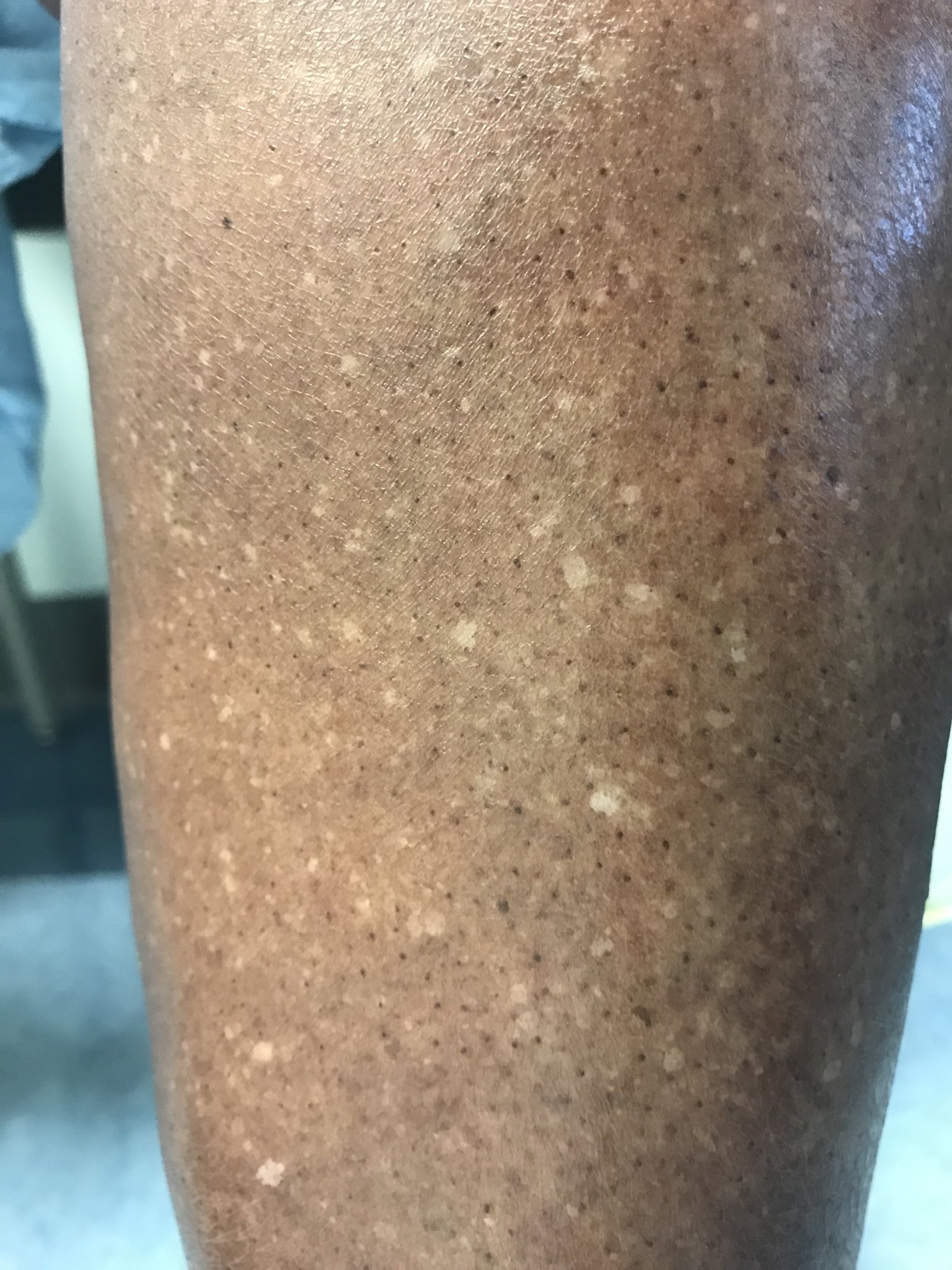 Idiopathic clearance guttate hypomelanosis