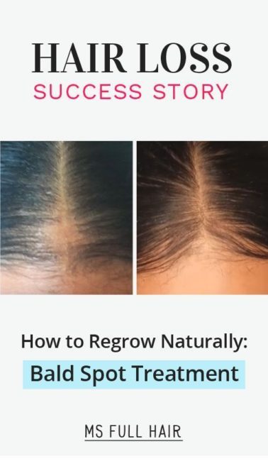 Hairlosswomen Hashtag On Twitter