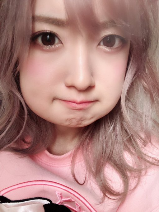 悲報 親知らずを抜いた須藤凛々花さん 顔がパンパンに腫れ上がり 見るも無残な姿に