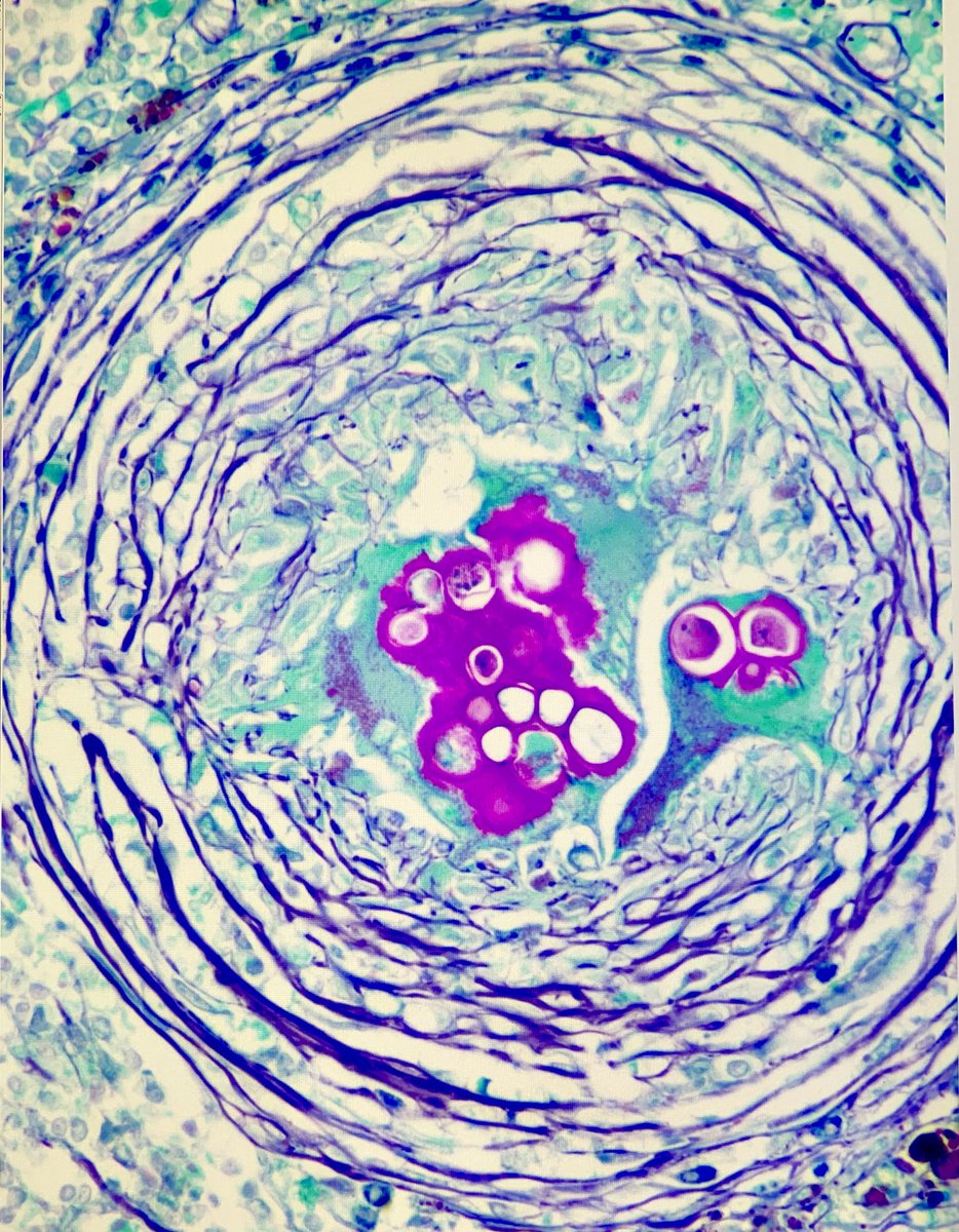 That feeling when you realize the wall is being built around you. #cocci #valleyfever #pathology #dermpath