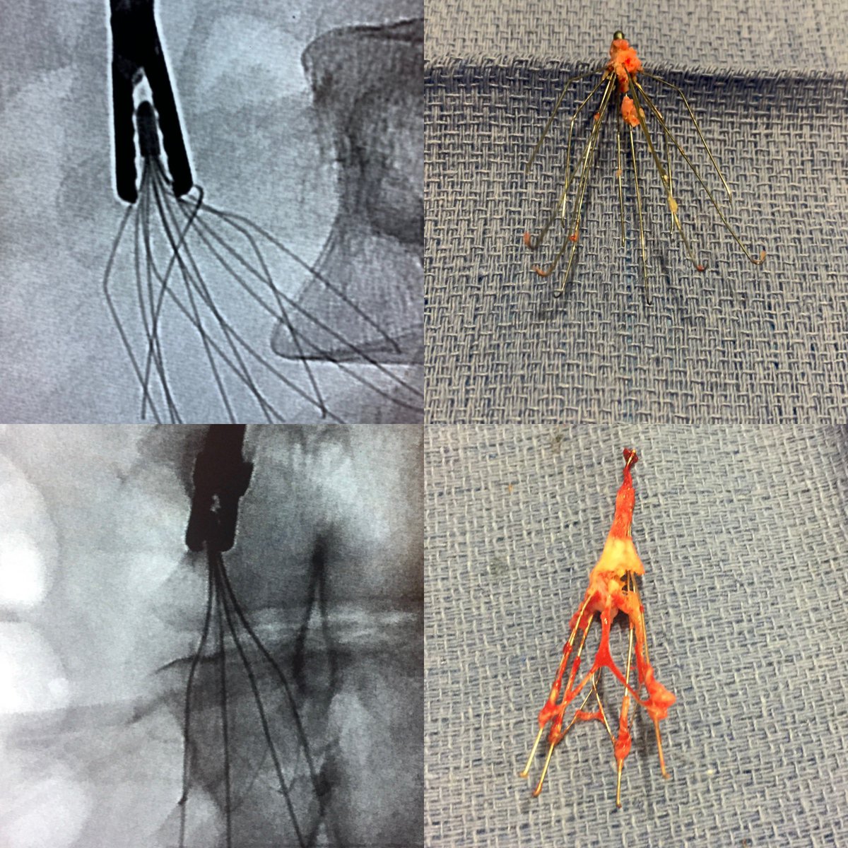 Kush Desai (@kush_r_desai) on Twitter photo #FilterThursday <a href="/NorthwesternIR/">NorthwesternIR</a> with Forceps delivery of a pair of 11 year old filters; G2 and Tulip. In centers with retrieval expertise, #filterOUT can be safely performed regardless of dwell time. <a href="/rkryu/">RK RYU</a> <a href="/SIRspecialists/">Society of Interventional Radiology</a> <a href="/rkryu/">RK RYU</a> <a href="/RKolluriMD/">Raghu Kolluri</a> <a href="/VIVAPhysicians/">The VIVA Foundation</a> #FilterThursday <a href="/NorthwesternIR/">NorthwesternIR</a> with Forceps delivery of a pair of 11 year old filters; G2 and Tulip. In centers with retrieval expertise, #filterOUT can be safely performed regardless of dwell time. <a href="/rkryu/">RK RYU</a> <a href="/SIRspecialists/">Society of Interventional Radiology</a> <a href="/rkryu/">RK RYU</a> <a href="/RKolluriMD/">Raghu Kolluri</a> <a href="/VIVAPhysicians/">The VIVA Foundation</a>