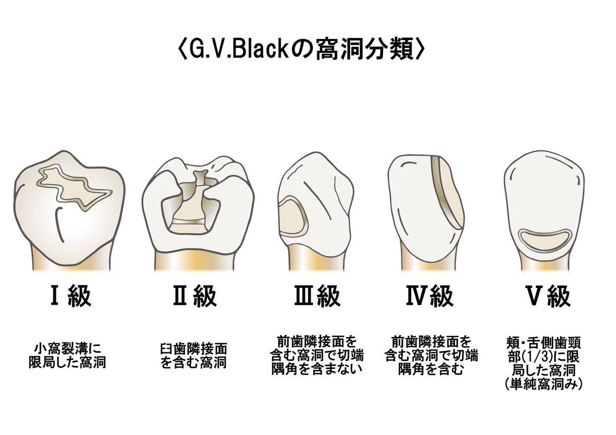 歯科衛生士のための一問一答 Auf Twitter G V Blackの窩洞分類 窩洞の分類は臨床でも良く使われます 視覚的にイラストで見ると覚えやすいです