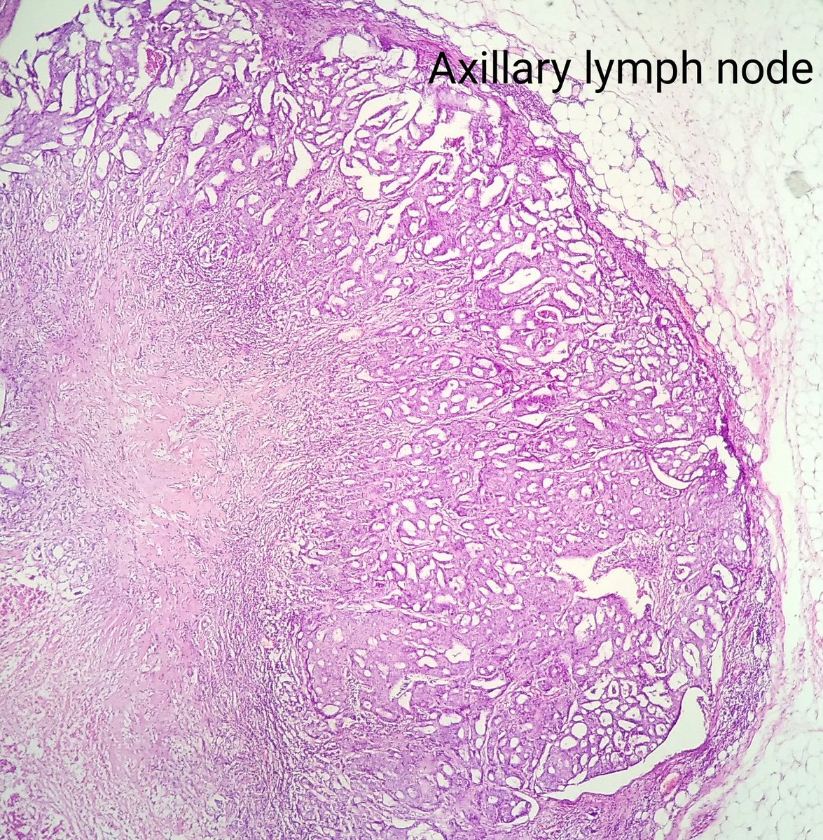 DrNishatAfroz2's tweet photo. Radical mastectomy! Not to miss out the real morphology !! Lymph nodes showing invasive CA; cribriform type! However Primary breast is showing fixation artefacts owing to rough handling of unfixed specimen.#Pathology
#pathologists #HumanPathology #DiagnosticPathology https://t.co/Pcrpo6wLbb