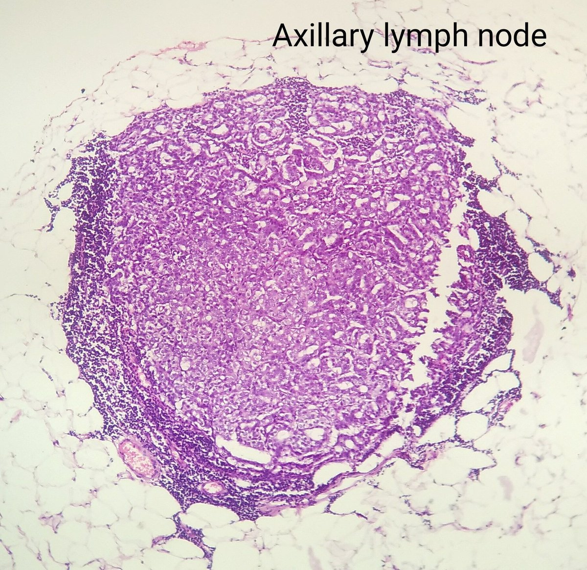 DrNishatAfroz2's tweet photo. Radical mastectomy! Not to miss out the real morphology !! Lymph nodes showing invasive CA; cribriform type! However Primary breast is showing fixation artefacts owing to rough handling of unfixed specimen.#Pathology
#pathologists #HumanPathology #DiagnosticPathology https://t.co/Pcrpo6wLbb