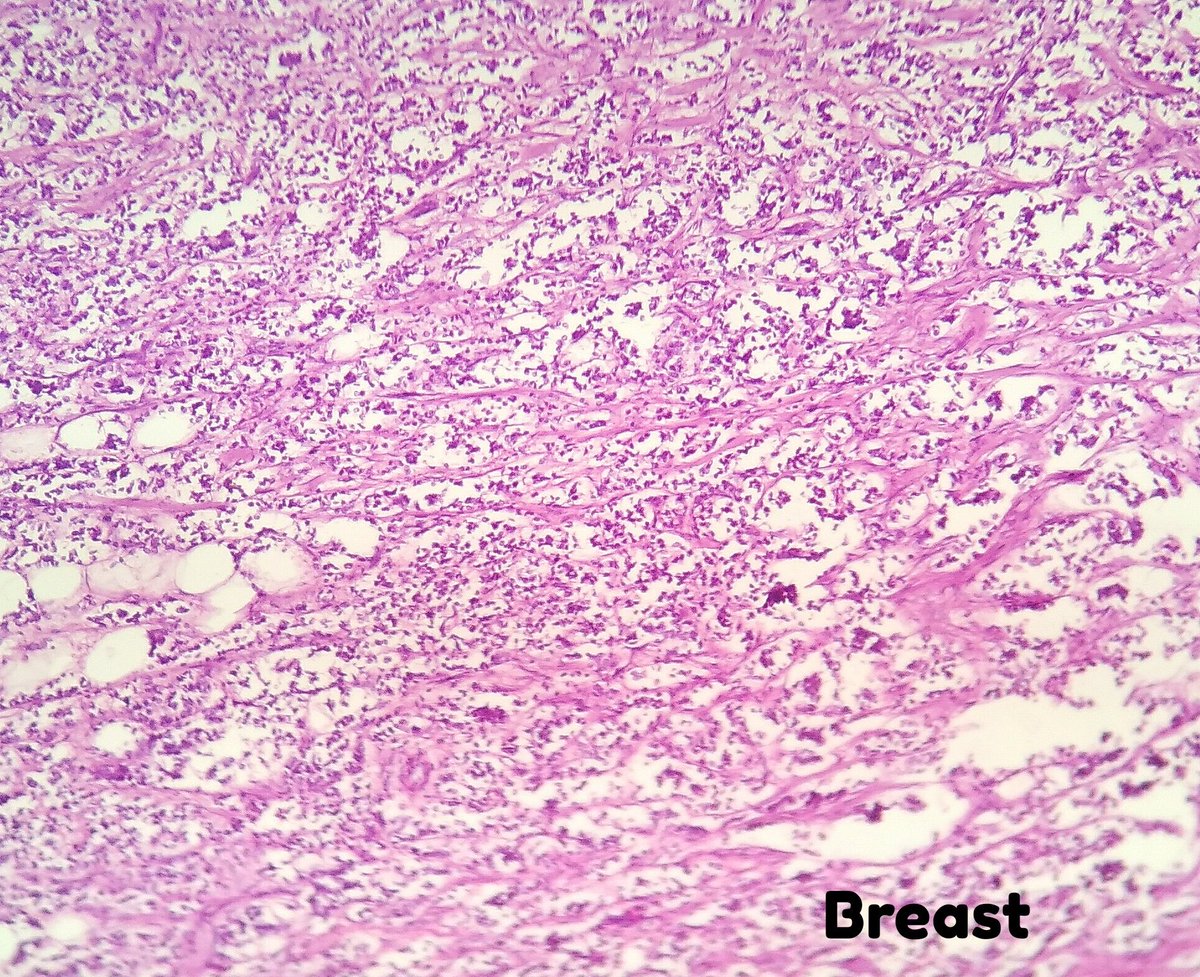 DrNishatAfroz2's tweet photo. Radical mastectomy! Not to miss out the real morphology !! Lymph nodes showing invasive CA; cribriform type! However Primary breast is showing fixation artefacts owing to rough handling of unfixed specimen.#Pathology
#pathologists #HumanPathology #DiagnosticPathology https://t.co/Pcrpo6wLbb