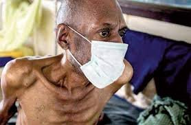 wcim2018's tweet photo. #WCIM2018 #Tuberculosis in older adults often presents atypically and is more common than one might think @Mediclinic @ehhc_kzn @busamed @LifeHealthcare_ @WesternCapeGov @chtrust1 #Share #SundayLearning #physiciansCapeTown https://t.co/2yCavI85NN