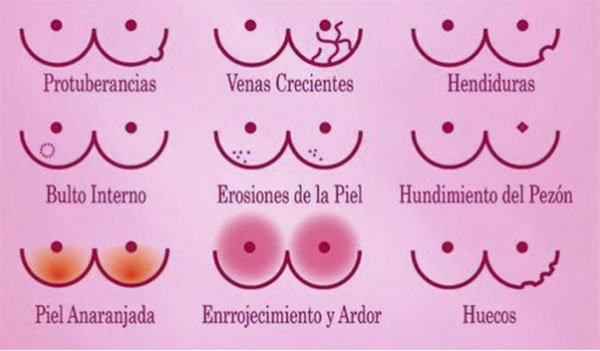 AnnaVallve's tweet photo. El #cancerdemama afecta a 1 de cada 8 dones. És el tumor més freqüent en les dones occidentals, i m��s en les africanes a causa de múltiples trets genètics.
Detectar-lo a temps podria salvar milers de vides. Estiguem alerta amb els símptomes dones! ♀️
@BIOJSGervasi https://t.co/glQnAGFhmw