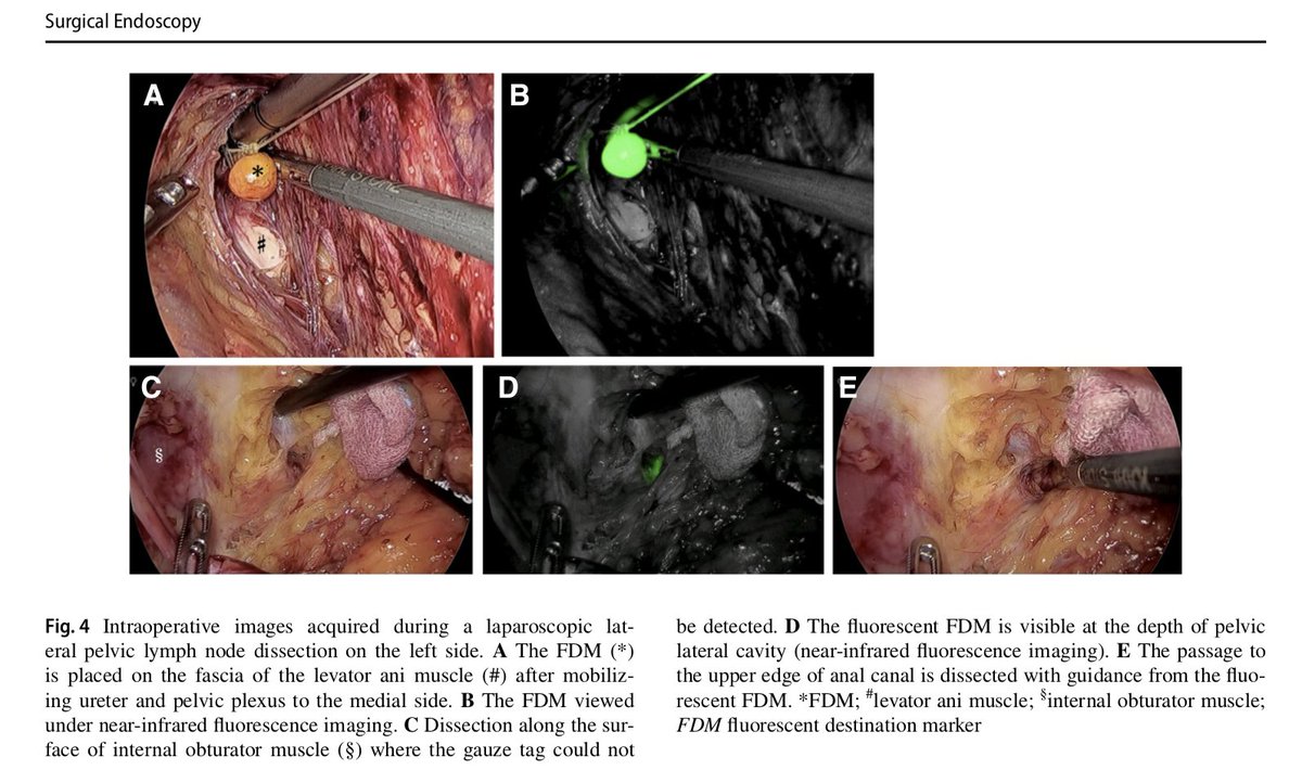 ICG fluorescence-guided laparoscopic surgery, with omental appendices as fluorescent markers for #colorectalcancer resection @SurgEndosc @SAGES_Updates  #FluorescenceImaging #colorectalsurgery #colorectalresearch rdcu.be/9KCF