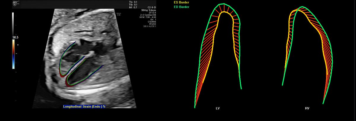 BarbDelPrince's tweet photo. #Congenitalheartdefects affect 1 out of every 110 babies worldwide. #Voluson technology can help evaluate the size, shape and contractility of the #fetalheart to detect critical abnormalities earlier. #2018ISUOG #ultrasound #fetalHQ #OBGYN #HealthierFutureForWomen https://t.co/XpWTuw5RIp