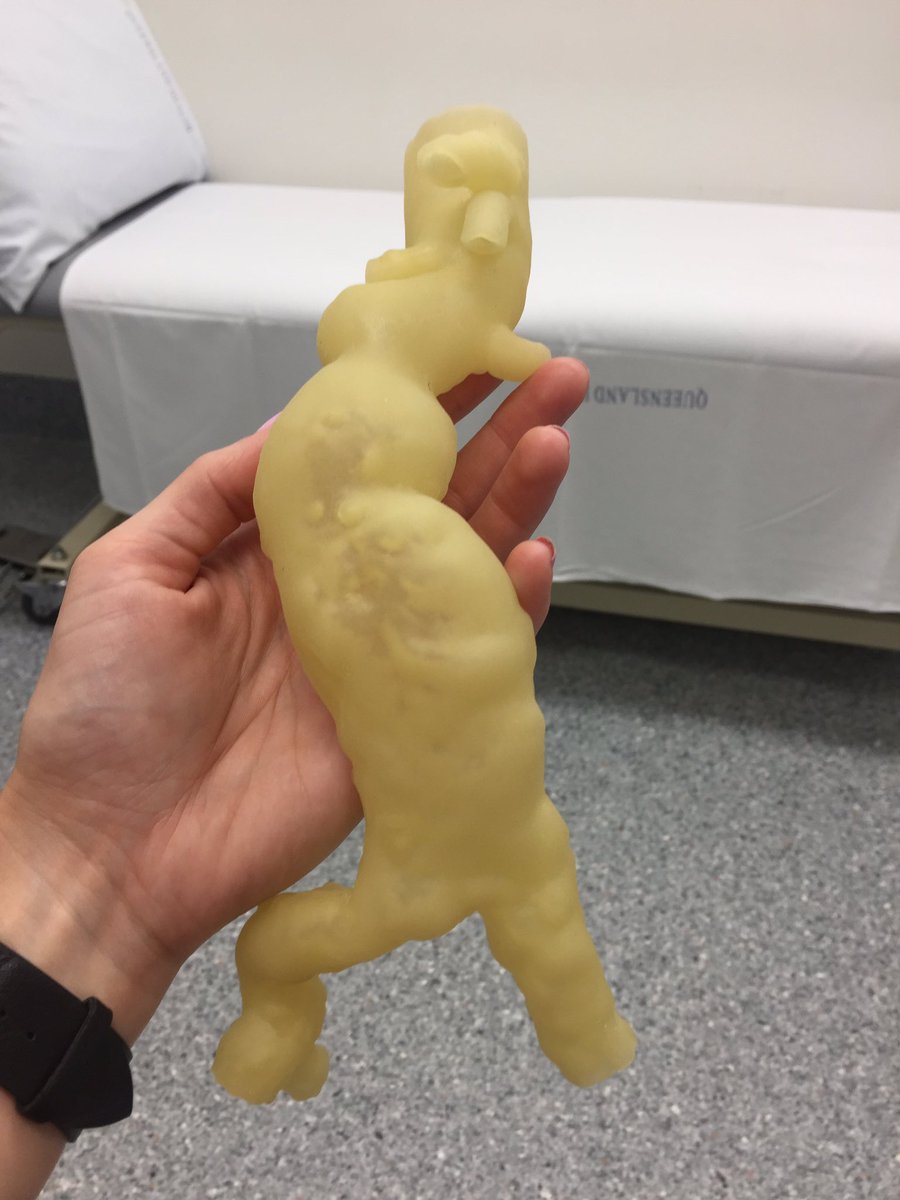 You beauty! #3dprinted aortic model in flexible elastomeric material for #surgicalplanning