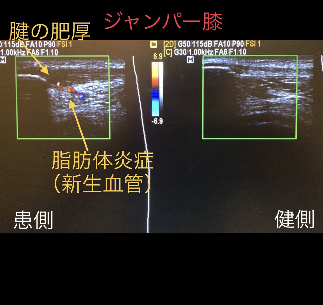 新盛淳司 鍼灸師 スポーツトレーナー メディカル No Twitter ジャンパー膝 練習をやすまなきゃいけないタイミング ジャンパー膝 超音波エコー 膝蓋腱断裂 膝蓋下脂肪体 ブログ書きました T Co Oehvoutv4v 新盛淳司 鍼灸師 スポーツトレーナー メディカル No Twitter ジャンパー膝 練習をやすまなきゃいけないタイミング ジャンパー膝 超音波エコー 膝蓋腱断裂 膝蓋下脂肪体 ブログ書きました T Co Oehvoutv4v