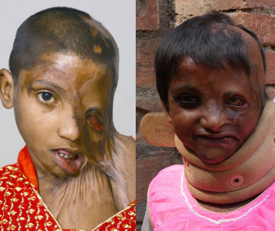 StopAcidAttacks's tweet photo. Meet 7 year old girl julie from fatehpur (U.P),When she was only 2 yr old her step father acid attacked her in midnight at home. She will need many more surgeries and more love and care so that #SheDreamsAgain. 
To Support : https://t.co/JcVmdguyG6
Bring support to her. https://t.co/j0SsPM4uZA