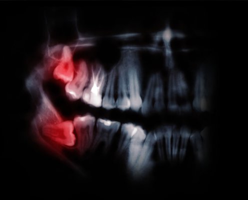 wisdomteeth_dr's tweet photo. Do not ponder like Hamlet, "To Extract Or not to Extract." Learn more interesting facts on #WisdomTeeth at #Wisdomteethdentist.  Have the Impacted Molars Removed By a #Dental Expert... https://t.co/fdTeYDsJZV https://t.co/hYgmX5b2FI