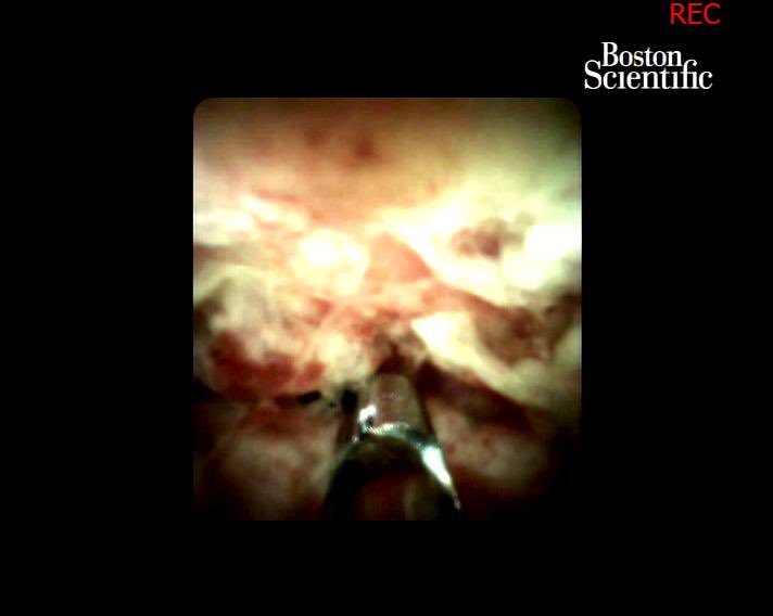 alerepici's tweet photo. T10: you could also use in intra-operative mapping of IMPN, for removal of foreign bodies within the bile duct or for transpapillary gallbladder drainage for acute #cholecistitis #smartstonemanagement #BSC_endoscopy #UEGweek #GWebster_endo #UEGweek https://t.co/KfvufGdhc0