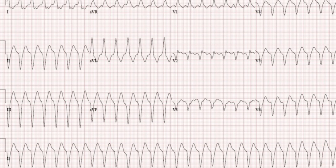 EPLabDigest's tweet image. Amiodarone-Sotalol Combination for Refractory Ischemic #VTach: A Valid Approach? ow.ly/33Ot30mhIWv