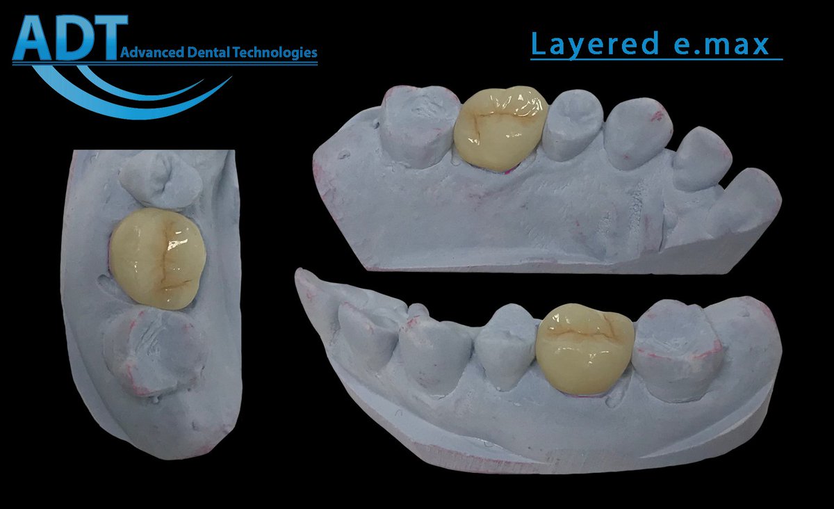 AdvDntlTech's tweet photo. https://t.co/UPQn2o6Yuv
#ADT #AdvancedDentalTechnologies #AdvancedDentalLab #Teeth #LoveOfTeeth #LayeredEmax #emax #IntraOralScanning #TRIOS #Cerec #iTero #TrueDefinition #DentalLab #SendUsYourScans #SendUsYourImpressions https://t.co/U0vOBJtnVi