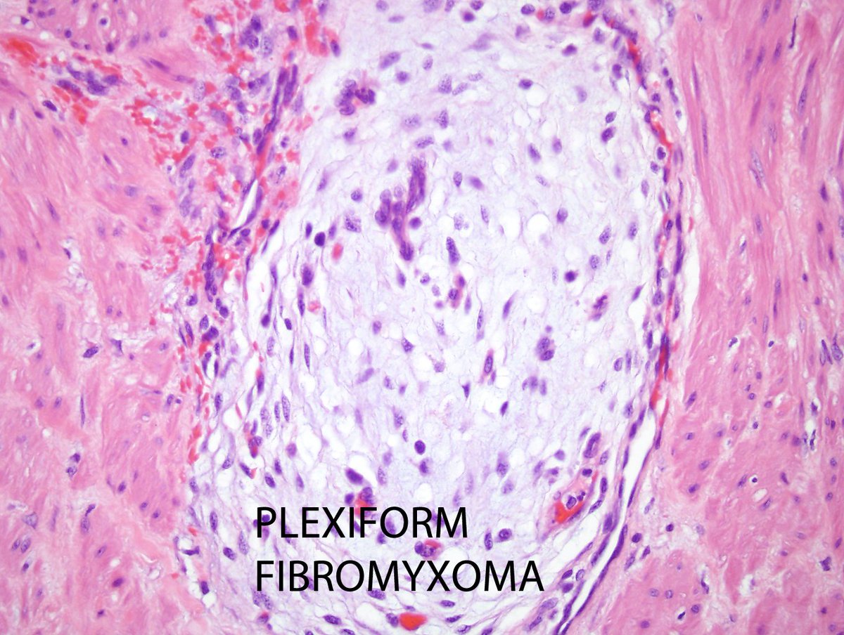Elizabeth Montgomery, MD (@lizmontgomerymd) on Twitter photo Morphology remains critical in the genomic era; Two lesions of the gastric muscularis propria with MALAT1-GLI1 fusions; one (gastroblastoma) is malignant and the other (plexiform fibromyxoma) benign. Morphology remains critical in the genomic era; Two lesions of the gastric muscularis propria with MALAT1-GLI1 fusions; one (gastroblastoma) is malignant and the other (plexiform fibromyxoma) benign.