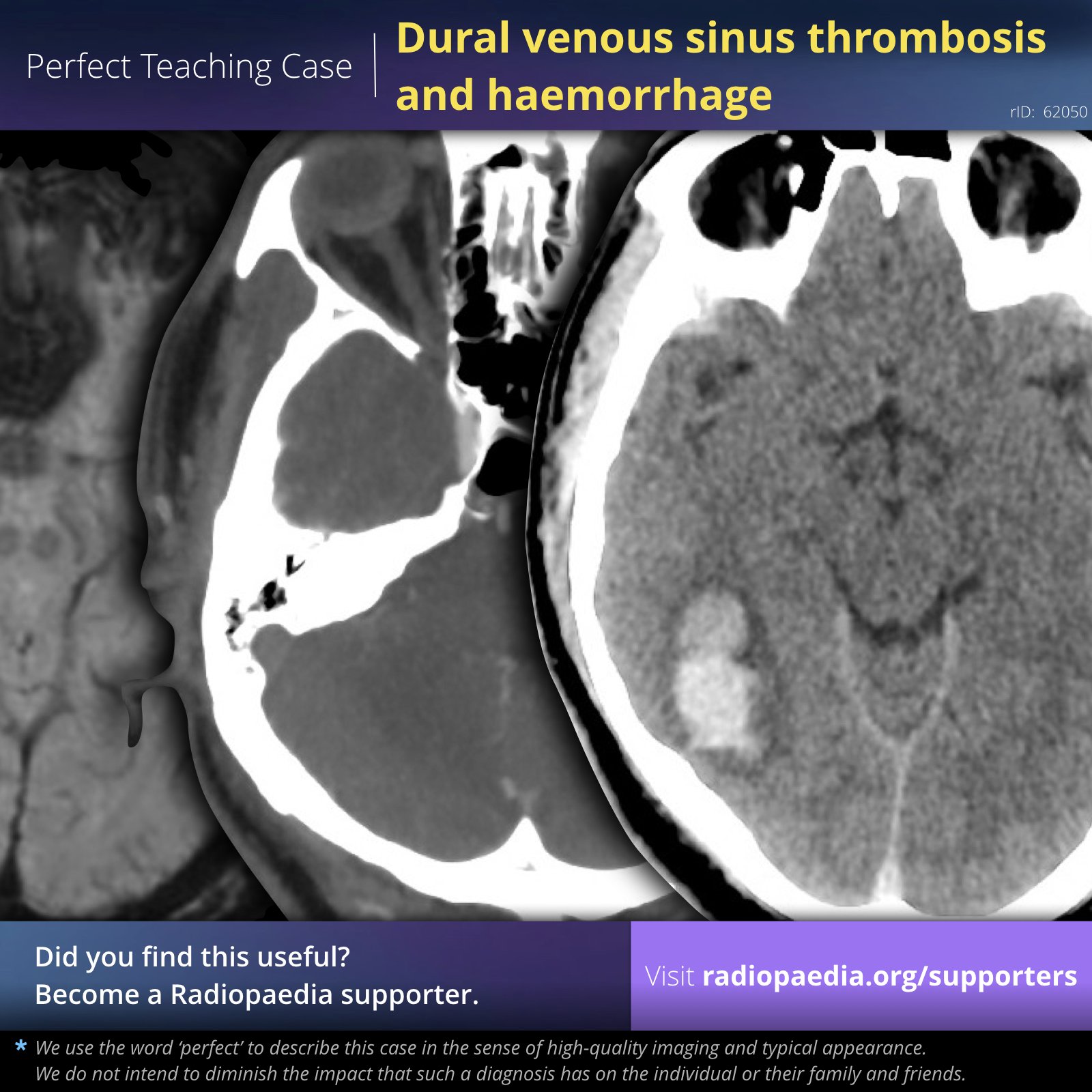 Frank Gaillard Perfect Teaching Case Dural Venous Sinus Thrombosis And Haemorrhage Mri And Ct View Case T Co Mczbyhi2mb Become A Radiopaedia Supporter T Co Uoz174knzo Supportradiopaedia Radiology Foamed Foamrad Frank Gaillard Perfect Teaching Case Dural Venous Sinus Thrombosis And Haemorrhage Mri And Ct View Case T Co Mczbyhi2mb Become A Radiopaedia Supporter T Co Uoz174knzo Supportradiopaedia Radiology Foamed Foamrad