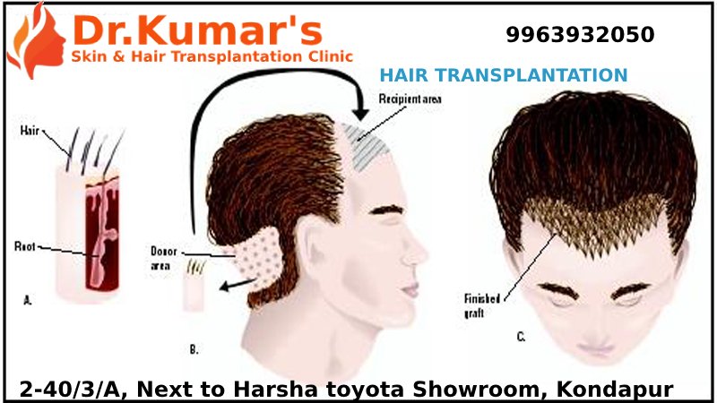 drashokkumar143's tweet image. Hair Transplantation in Hyderabad
thehaircare.co.in
Best Hair Transplantation clinic in Hyderabad. No Pain , 100% Results.
#Hair_Transplant
#Hair_Transplantation_in_Hyderabad
#Hair_Transplantation