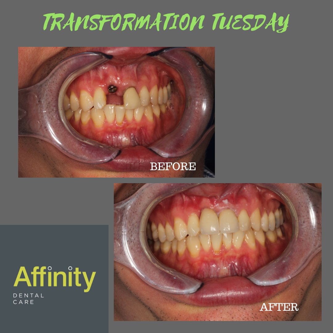 affinitydencare's tweet photo. Another great result for a very happy patient. Transform your smile today with our team at Affinity Dental Care https://t.co/R3wYWvbE4q