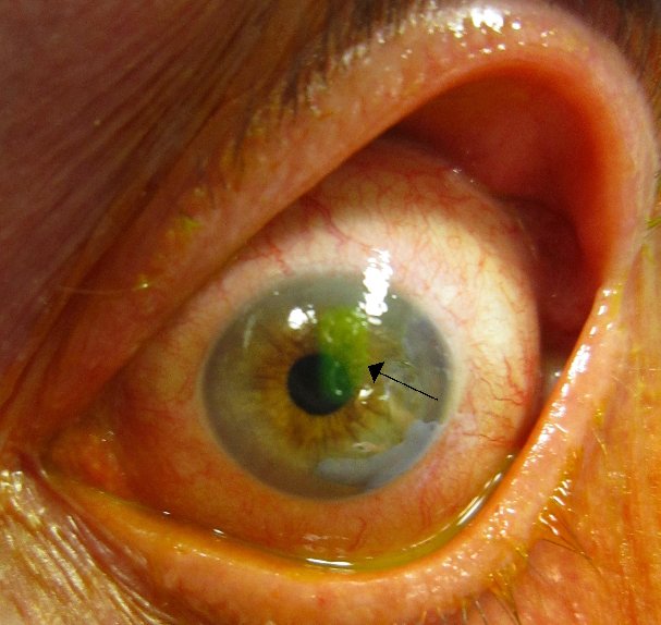 Moorfields's tweet image. Condition of the week: #corneal abrasion is a scratch on the clear part of the front of your eye. bit.ly/2ILam1L #MoorfieldsConditions