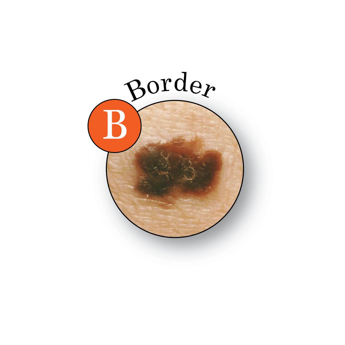 AADskin's tweet photo. Use the ABCDEs of #melanoma to check your skin. If you notice anything new, changing, itching, or bleeding, see a board-certified dermatologist for diagnosis and treatment. #MoleDay https://t.co/4fQZv2eTUa https://t.co/2UWt6x9oeD