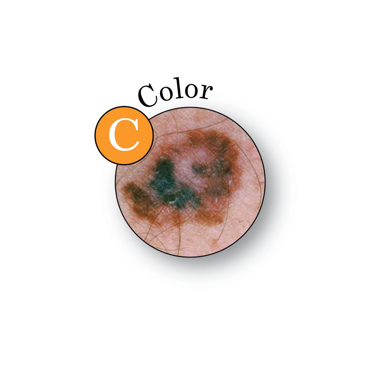 AADskin's tweet photo. Use the ABCDEs of #melanoma to check your skin. If you notice anything new, changing, itching, or bleeding, see a board-certified dermatologist for diagnosis and treatment. #MoleDay https://t.co/4fQZv2eTUa https://t.co/2UWt6x9oeD