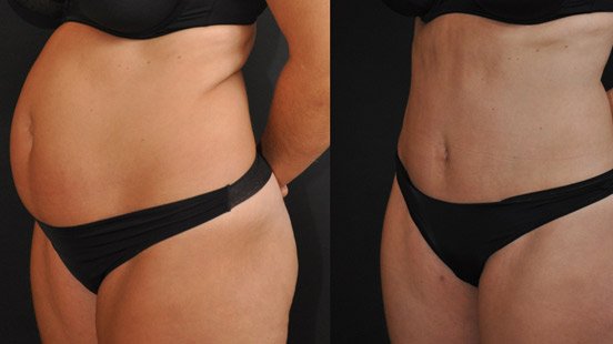 Хулахуп для похудения живота и боков. Липосакция липоскульптурирование. Круглый животик. Как убрать круглый живот. Как убрать круглый живот.