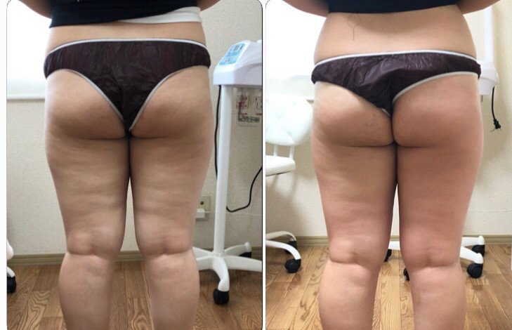 ট ইট র 袋井市 小顔矯正サロン リラッシュ 袋井市初上陸の次世代美容機器 Hifu ハイフ 大好評です リバウンドなし 食事制限なしで 痩せられます コチラのお客様は 2か月で太もも 4センチ 太もも裏のセルライトもなくなっているのがお写真でわかり