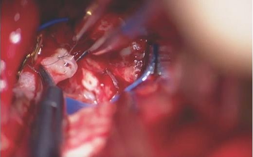Neurosurgery Publications (@neurosurgerycns) on Twitter photo Free Video in Op Neurosurgery by Burkhardt et al. <a href="/NeurosurgeryUSC/">USC Neurosurgery</a>! A2 Anterior Cerebral Artery-to-A3 Anterior Cerebral Artery Interpositional Bypass with Radial Artery Graft for a Ruptured Mycotic Fusiform Aneurysm: 2-Dimensional Operative Video bit.ly/2q5twrt #ONSFree Free Video in Op Neurosurgery by Burkhardt et al. <a href="/NeurosurgeryUSC/">USC Neurosurgery</a>! A2 Anterior Cerebral Artery-to-A3 Anterior Cerebral Artery Interpositional Bypass with Radial Artery Graft for a Ruptured Mycotic Fusiform Aneurysm: 2-Dimensional Operative Video bit.ly/2q5twrt #ONSFree
