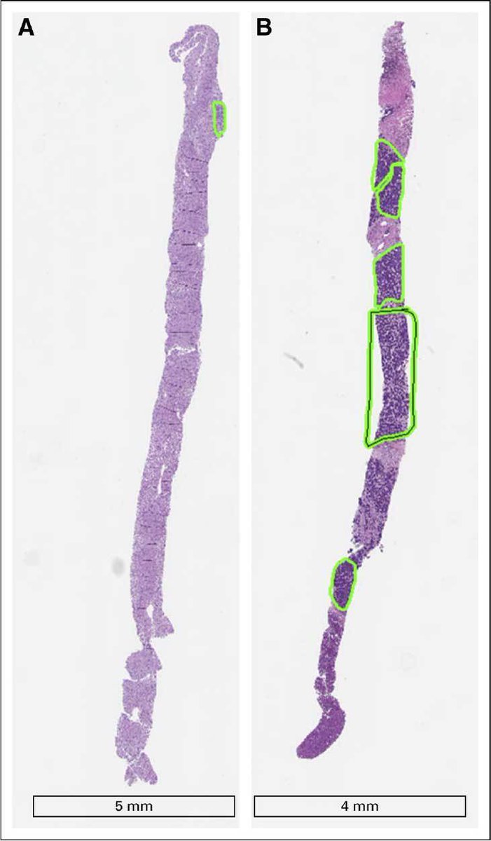 theNCI's tweet photo. Tumor biopsies collected for research often don't have enough of the tumor tissue (green blocks). A new study aims to change that: https://t.co/hpliPF4vUf @NCItreatment https://t.co/m8JNlPU3jj