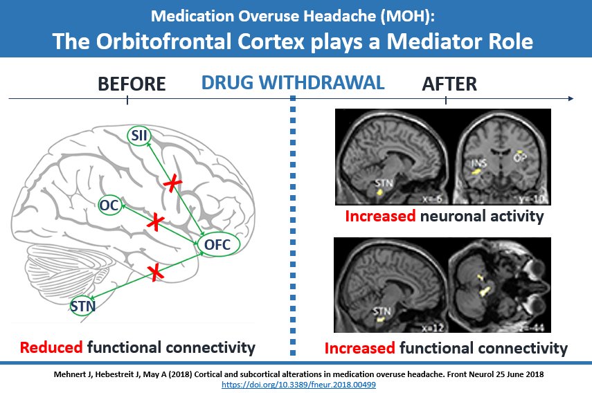 SFB_936's tweet photo. Functional cortical changes in MOH patients - the Orbitofrontal Cortex as a mediator between bottom-up and top-down stream
https://t.co/tYEzHhHodM
by Jan Mehnert from @HH_HRC
 
#Neurology #Migraine #MedicationOveruse  functional connectivity #fMRI 
#neuroscience https://t.co/3DPNGeMxce