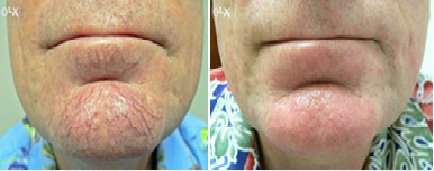 VBAesthetics's tweet photo. What is Thermavein?
๐ฏ removal of thread veins, spider naevi, skin tags..
๐ค delivers a current of energy to seal the vein.
โฐ 20-30 mins
๐ฑ minimal pain
๐ฐยฃ75-ยฃ150
๐ฉ๐ปโCons - Free
T 07843437388
#threadvein #redveins #thermavein #saddleworth #oldham #skincare #nurse https://t.co/rX7GuCrcTH
