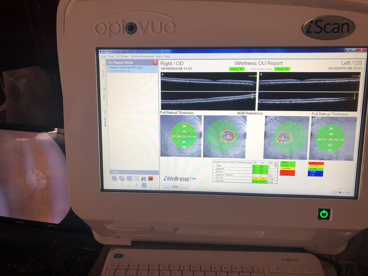 La lo comentamos en antena de <a href="/RadioMarcaTfe/">Radio MARCA Tenerife</a>, nuevo servicio de OCT (Tomografia de coherencia óptica) en <a href="/OpticaCandilas/">Optica Candilas</a>