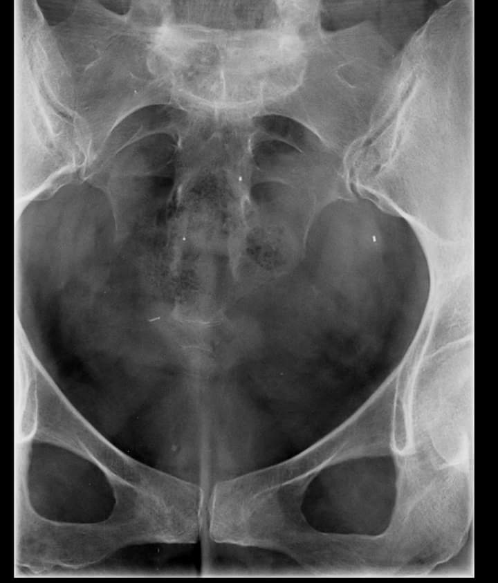 lapastorina's tweet photo. 1 operación retirada de #essure
Sólo trompas, 
2 operación restos de una mala primera operación y con la negativa de los @ginecologos que aún dicen que no pasa nada!
Hasta 5 restos le quitaron a esta afectada pagándolo de su bolsillo Hasta cuándo?
@libreessure 
@Bayer 
@AEMPSGOB https://t.co/QH37gqBxhL