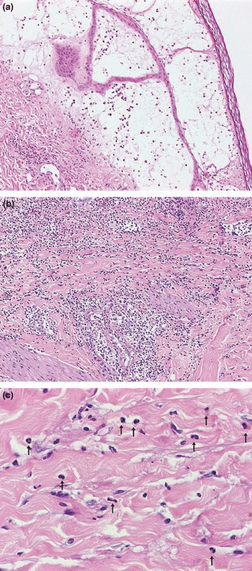 Erysipeloid: a review
onlinelibrary.wiley.com/doi/10.1111/j.…
Erysipeloid is a skin infection caused by traumatic penetration of Erysipelothrix rhusiopathiae. The disease is characterized clinically by well‐defined, erythematous oedema, with raised borders, usually on the dorsal hand/fingers.